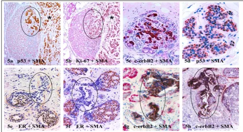 Fig 5. Comparison of the growth pattern and molecular profiles in potential precursors of invasive lesions