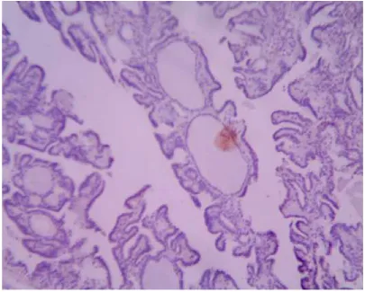 Fig 2 papillary hyperplasia in Multinodular goitre shows negative stain.