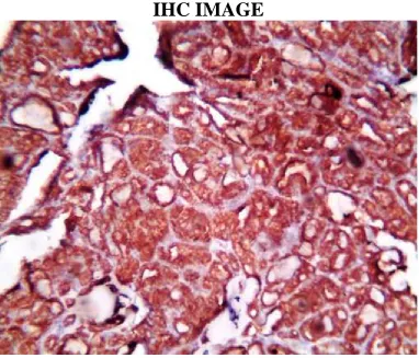 FIG 1 PAPILLARY CARCINOMA DIFFUSE POSITIVITY