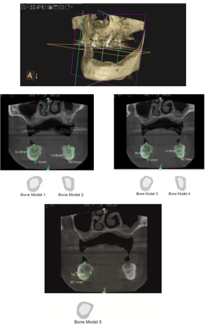 Fig 1. 3D view of mandible and two dimensional sketch of five mandibular segment from CBCT scan 