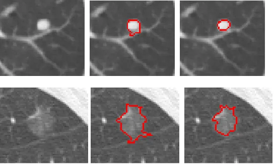 Fig.1. Two examples of nodule segmentation. 1 st column: original sub-image; middle column: segmentation results based on mean shift without the shape feature; 3st column: segmentation results based on the proposed method