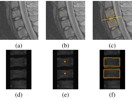 Figure 5. Segmentation approach.Origi-nal image (a), seeds overlaid (b), and ﬁnalsegmentation result (c) with disk orientationdrawn as a line between vertebrae.