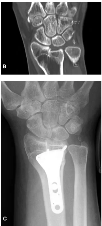 Figure 5:  A) Preoperative PA radiograph and B) CT scan and  coronal reconstruction image demonstrate an intra-articular  malunion with stepoff of the lunate facet