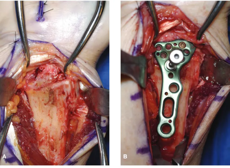 Figure 2:  A) Intraoperative picture showing volar exposure of the distal radius. The healed fracture line is clearly visible