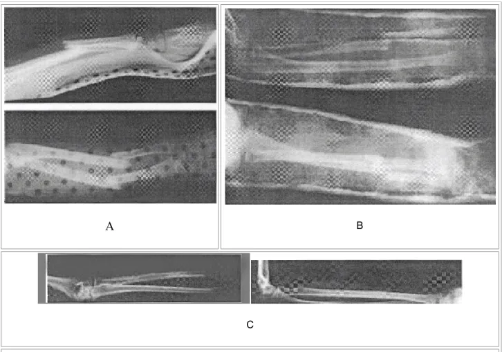 Fig. 2 A, Displaced midshaft fracture of the radius and ulna in a girl aged 9 years I month