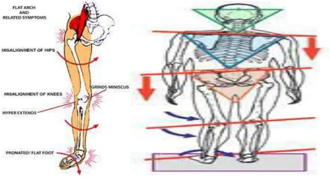 Figure 4. Figures showing complications of flat foot 