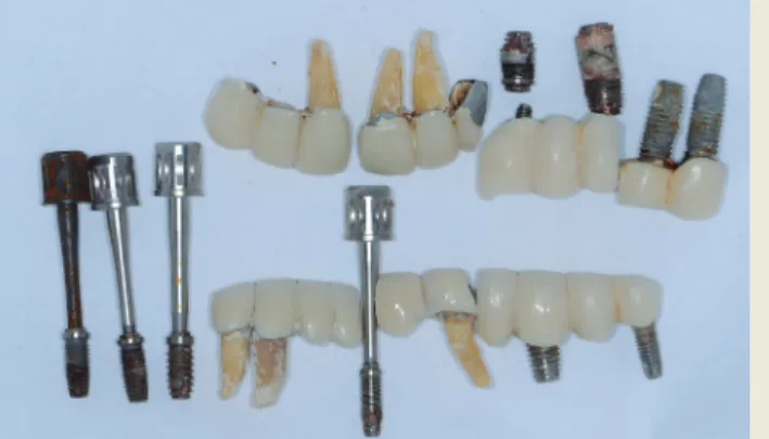 Figure 10. The healed maxillary and mandibular ridges  following implant removal