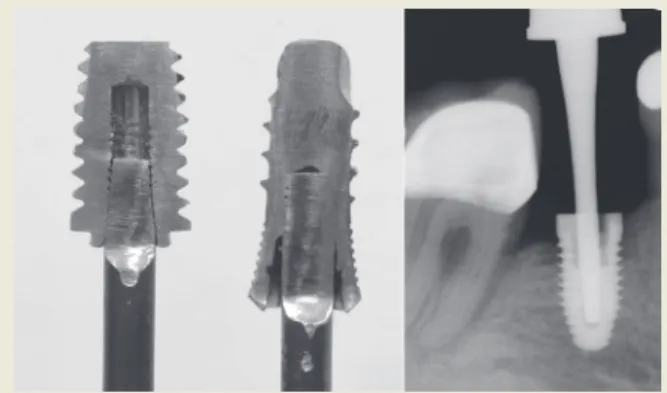 Figure 13. RST failed due to the circular thread   design of the implant