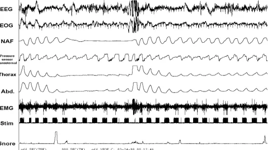 Figure 1 : Normal polysomnographic test graph which is obtained from overnight Polysomnography