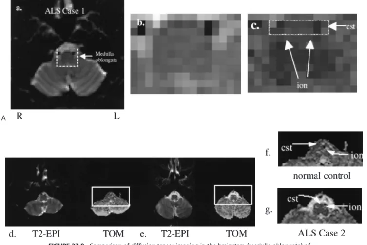 FIGURE 27.8. Comparison of diffusion tensor imaging in the brainstem (medulla oblongata) of a normal control (D,F) and two patients with amyotrophic lateral sclerosis, ALS case 1 (A–C) and ALS case 2 (E,G)