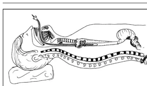 Figure 1 The esophageal photoplethysmographic probe con-tained within the stomach tube is shown placed in the eso-phagus via the mouth