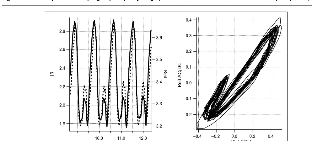 Figure 2 Short sample of the esophageal photoplethysmographic waveform with infrared and red traces superimposed (left)