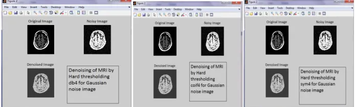 Fig: 5 Denoising of MRI by Hard Thresholding using db4, coif4, symlet4 for Gaussion noise Images   