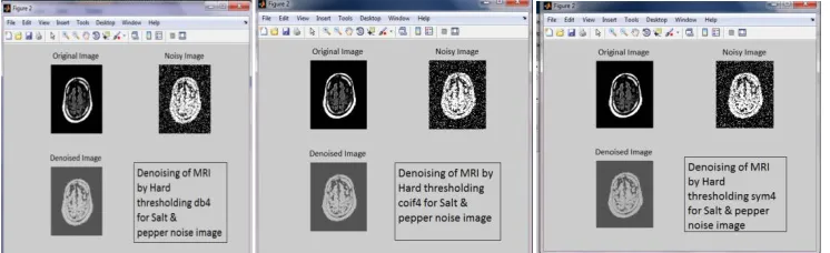 Fig: 8 Denoising of MRI by  Hard Thresholding using db4, coif4, symlet4 for Salt & pepper noise Images   