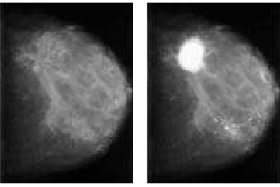 Figure 1.1: Typical mammogram