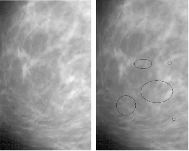 Figure 1.5: Simulation of microcalciﬁcations on normal mammograms region 2