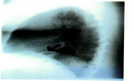 Fig.8: Xray abdomen erect view  