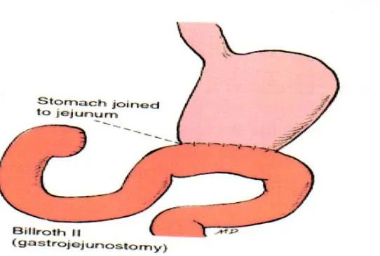 Fig 18: Billroth II gastrojejunostomy 