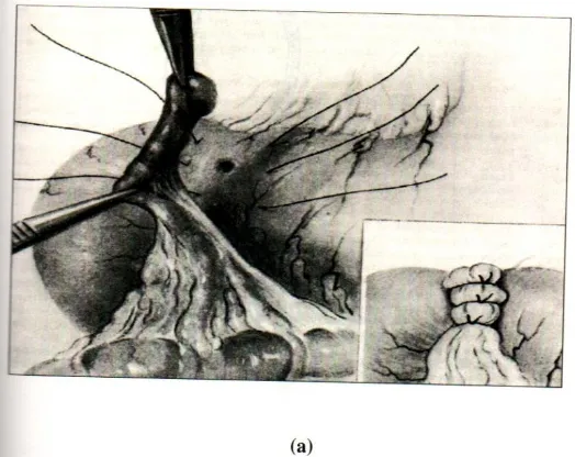 Fig.23: Grahams omental patch repair 