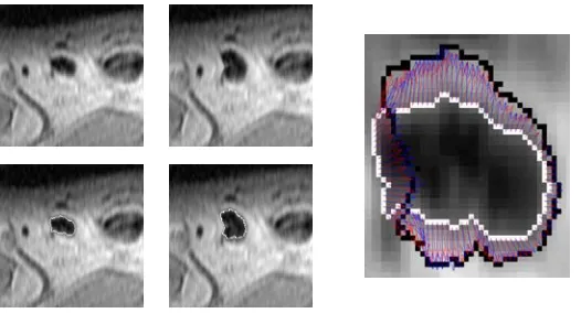 Fig. 6.Left: MR image segment including a lymph node without (top) and with the converged contour (bottom) ; Middle: Deformed image