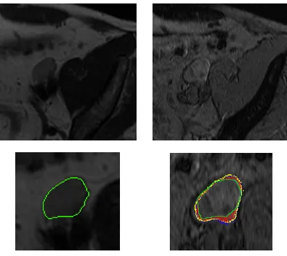 Fig. 10.Using a non-unit variance ﬂow, the node on the T2 image (green) is morphed onto the node on the T2* echo image (yellow) on