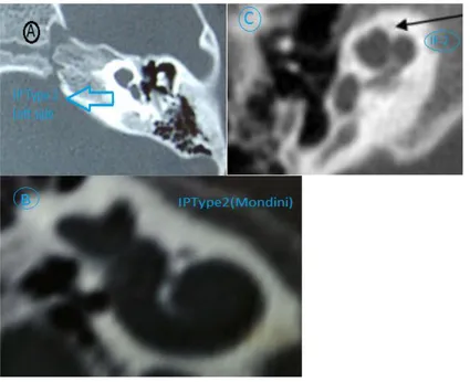 Figure 15 (A-C): Incomplete partition type II. Axial HRCT images (A, C) show  fusion of the middle and apical turns of the cochlea ( arrow in A&C) 