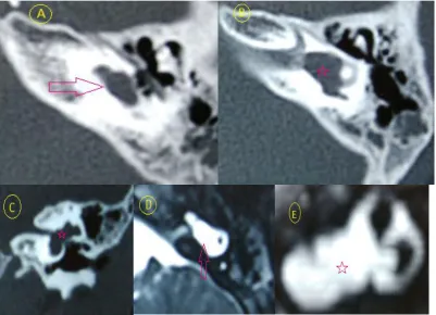 Figure 16 HRCT axial (A&B) images, coronal (C) image shows common cavity: Fig D Axial 3D-FIESTA images shows common cavity with IAM; Fig e3D-MIP reconstruction of the images showing common cavity  