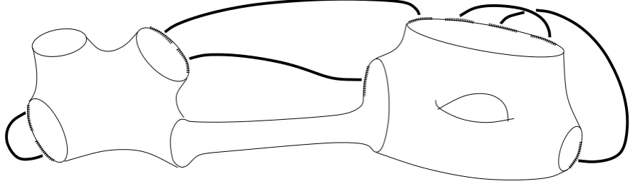 Figure 3. A prestable ribbon graphthat the edge G and its associated surface S(G). Note e itself forms a boundary component.