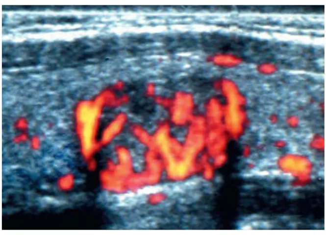 Fig 17. Power Doppler image shows that nodule is hypervascular and 
