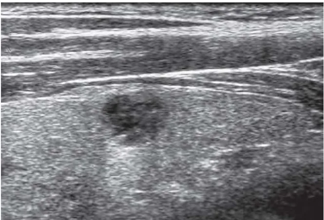 Fig 22.  images show a 1-cm solid  mass representing proven thyroid metastasis from renal cell carcinoma
