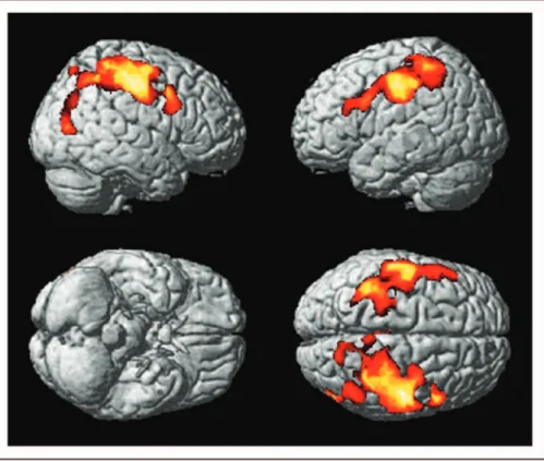Table 2. Clusters of significant grey matter loss that correlate with Expanded Disability Status Scale in patients with relapsing–