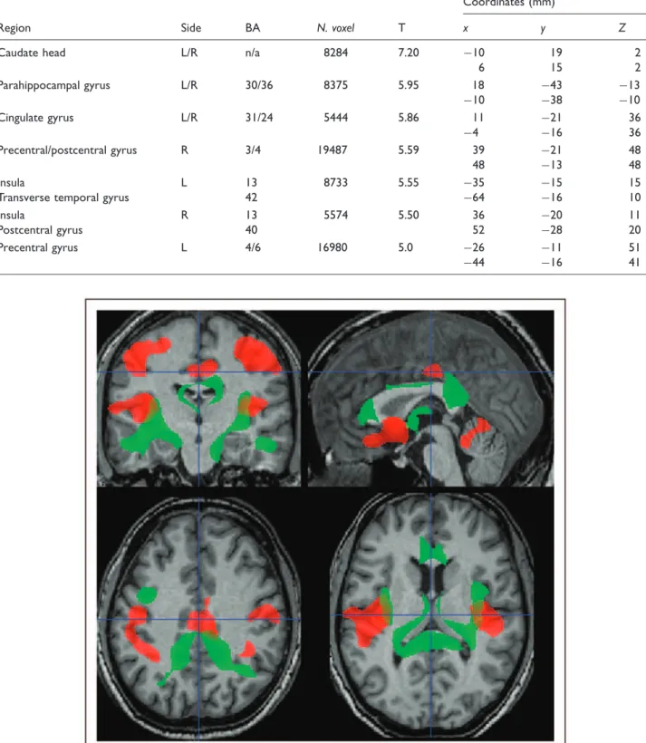 Figure 5. Regions of white matter loss (in green) that correlate with lesion load in patients with relapsing–remitting multiple sclerosis together with regions of grey matter loss (in red) for comparison (p < 0.05 corrected for multiple comparisons at c