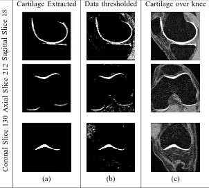 Fig. 18.M-VTS and manual segmentation comparison performed on the cartilage of ﬁgure 16 (a)
