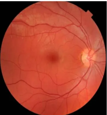 Fig : 1 Fundus photo of right eye showing normal fundus 