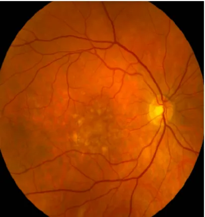 Fig : 5 Fundus photo of right eye showing soft drusen with 