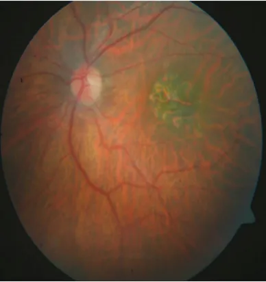 Fig : 6 Fundus photo of left eye showing Geographic atrophy 