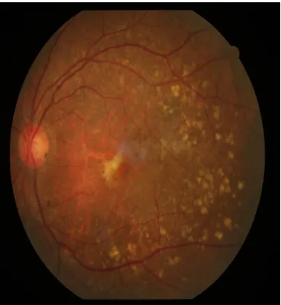 Fig : 7 Fundus photo of left eye showing active CNVM 