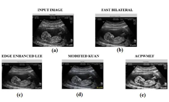 Fig.4 shows the Block Diagram of ACPWMEF.Normalize the noisy image, then compute the natural logarithm of the  normalized noisy image