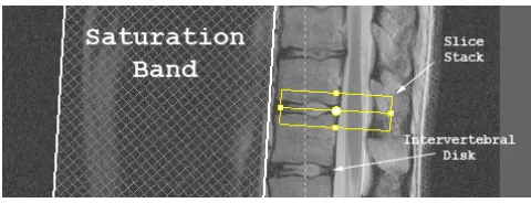 Figure 1. Sagittal view of the vertebral col-umn.The orientation of the intervertebraldisk is used to set up the slice stack.