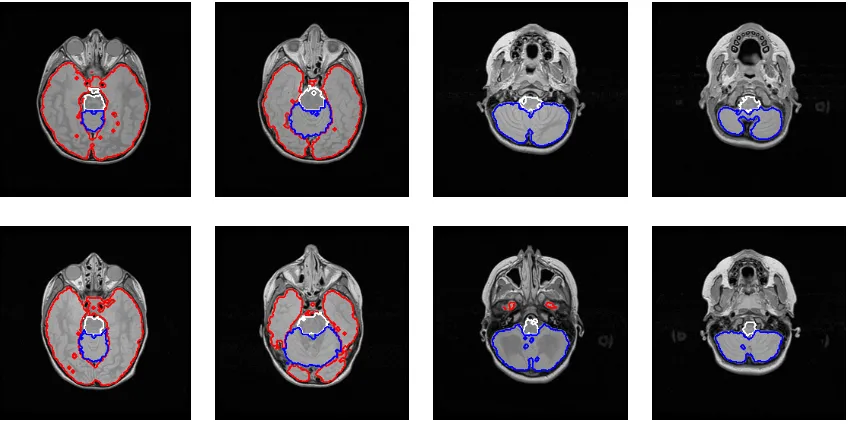 Fig. 5. MRI Brain segmentation. The contour of the cerebellum is not clearly deﬁned (a) but our algorithm is able to retrieve it(b).