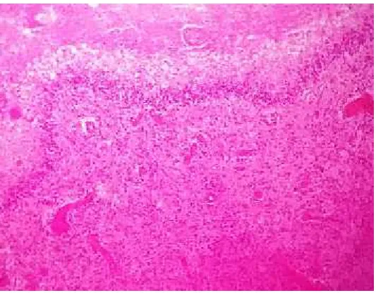 FIG 4: CAPILLARY HEMANGIOMA. H&E , (10x)