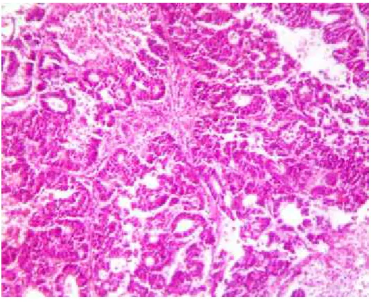 FIG 6a:WELL DIFFERENTIATED ADENOCARCINOMA COLON-LUMINAL MITOSIS H&E , (40x)