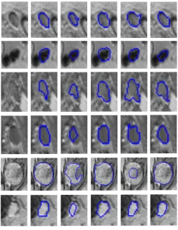 Fig. 3. Segmentation Results. Columns(a-f): a. ROI image; b. Node manually delineated; c