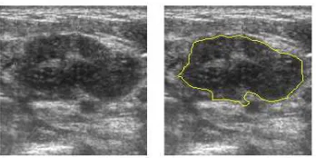 Fig. 5. A liver tumor is segmented using the Combined Algorithm on a CT volume.