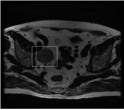 Fig. 1. Example of an MR image with a region of interest (ROI) around a lymph node.