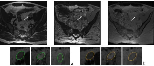 Fig. 2. The lymph node shows very different region and boundarycharacteristics in T2, T2* gradient echo 1 and 2 images (top fromleft to right)