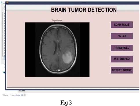  Fig 3 The watershed segmentation technique and filtration technique on two MRI image samples of different patients were 