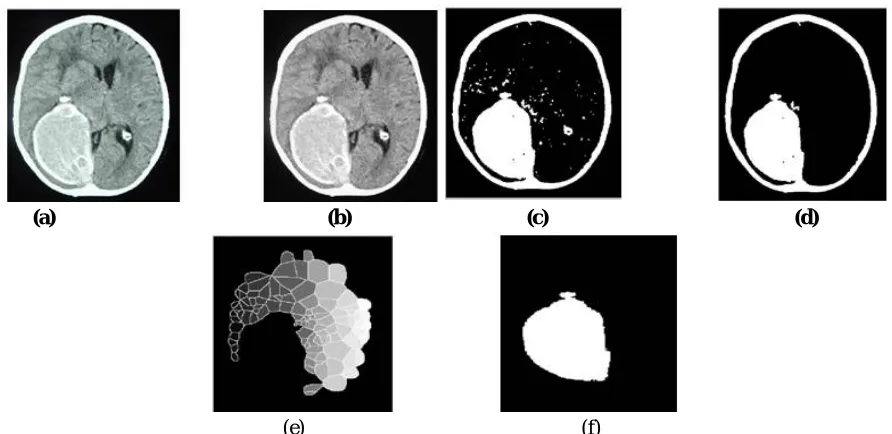 Fig 5. (a) Original input image of the patient having tumor in  the brain; (b) grey-level imaging is done in which the input image which is in rgb form is converted to gray level image; (c) image labelling is done on the gray level image which labels each 
