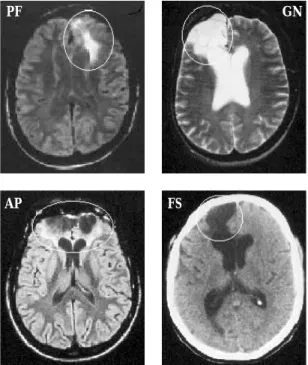 Fig. 9.1 MRI/CT brain scans of four neurological patients with rostral prefrontal damage