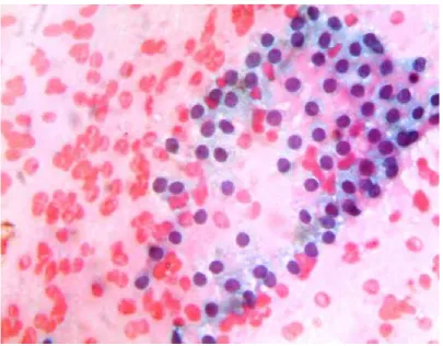 Fig 5: Paravacuolar granules in nodular goiter, Wright Giemsa, 100 X